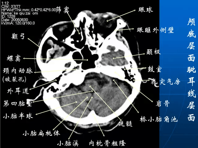 影像医生必须掌握的头颅ct解剖与常见出血梗死判读