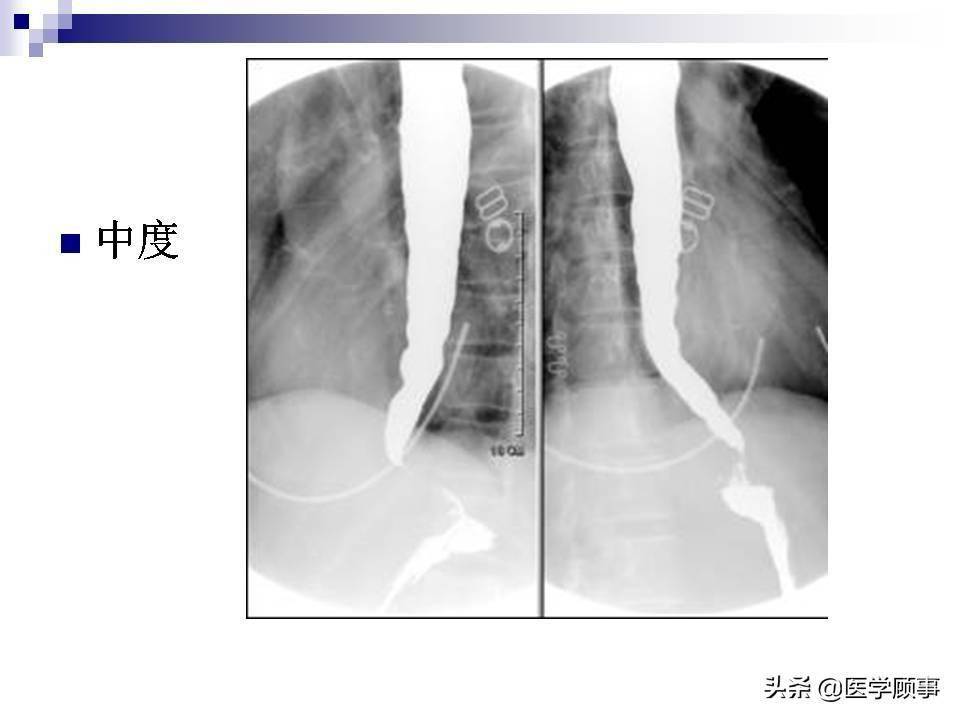 食道癌科普及影像分析