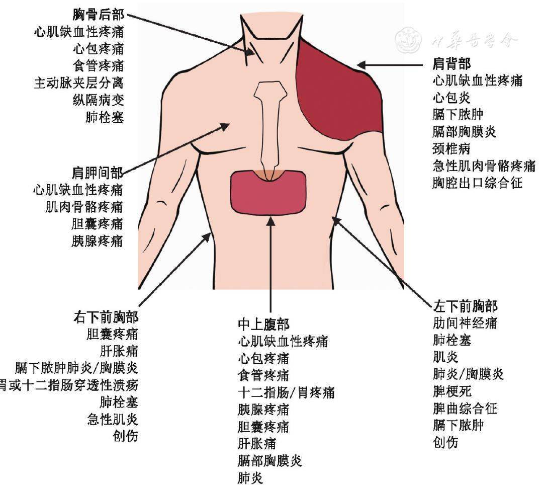 【基层常见疾病诊疗指南】胸痛基层诊疗指南(2019年)