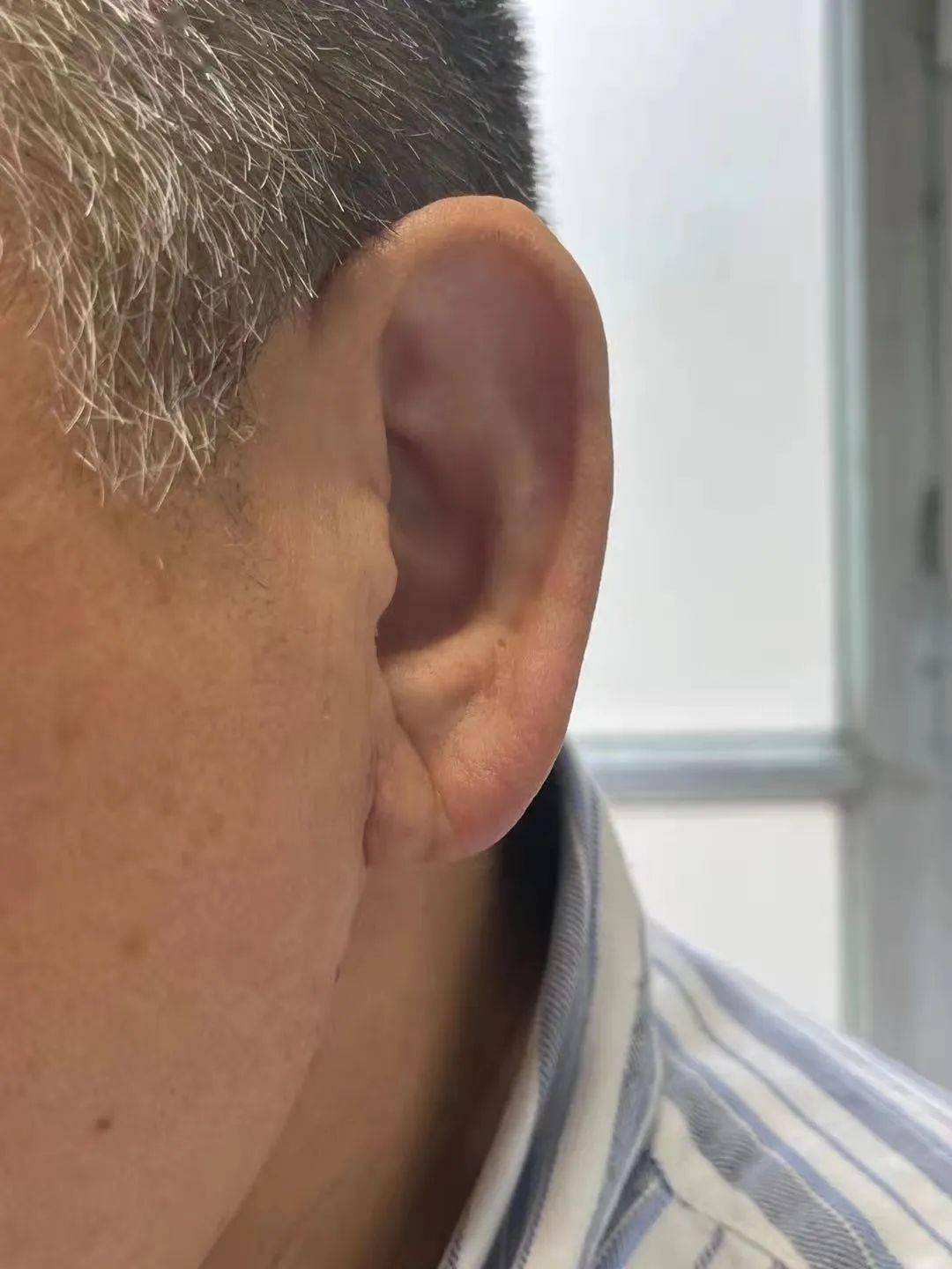 3月2日,我们发出北京医院汪芳教授的科普文章《耳折痕,是冠心病的