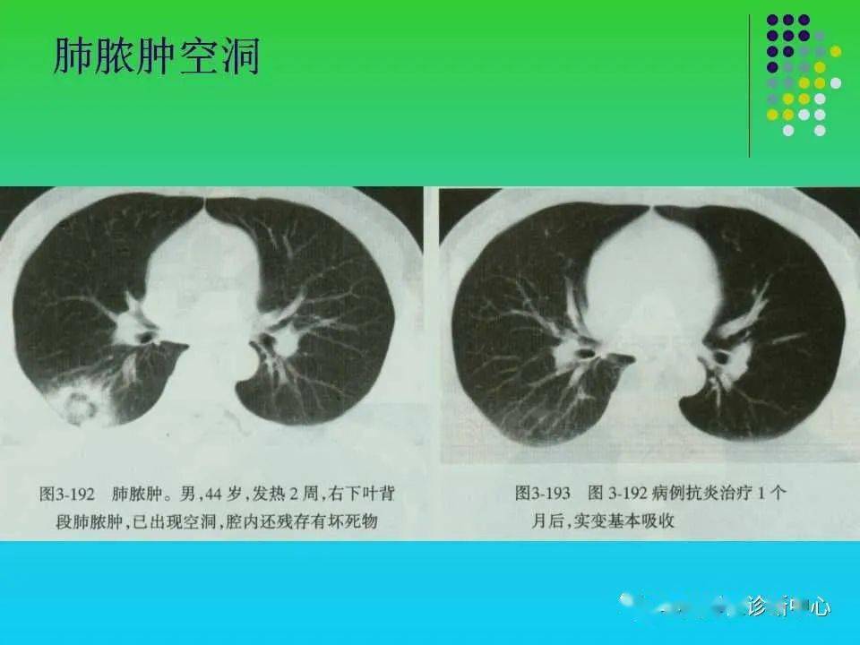 肺空洞性病变和囊性病变的ct诊断