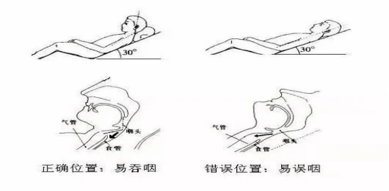 能坐起的患者取坐位,头部略前倾,避免食物误入气管,引起呛咳.