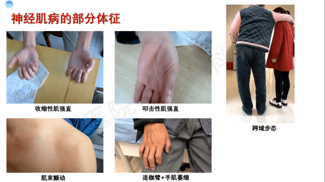 肌无力傻傻分不清?我来教你!