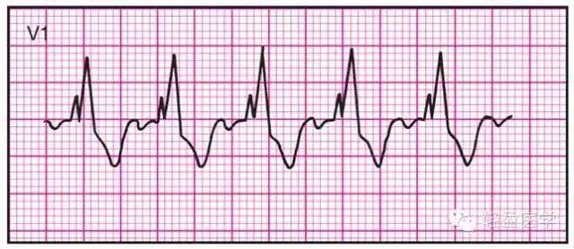 最全面的异常心电参考图,建议收藏!