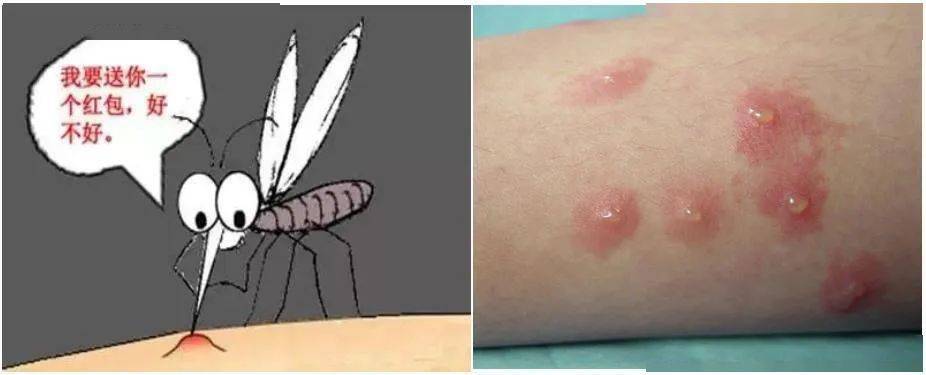 虫咬性皮炎又可称"丘疹性荨麻疹",主要与节肢动物的叮咬有关,常见的