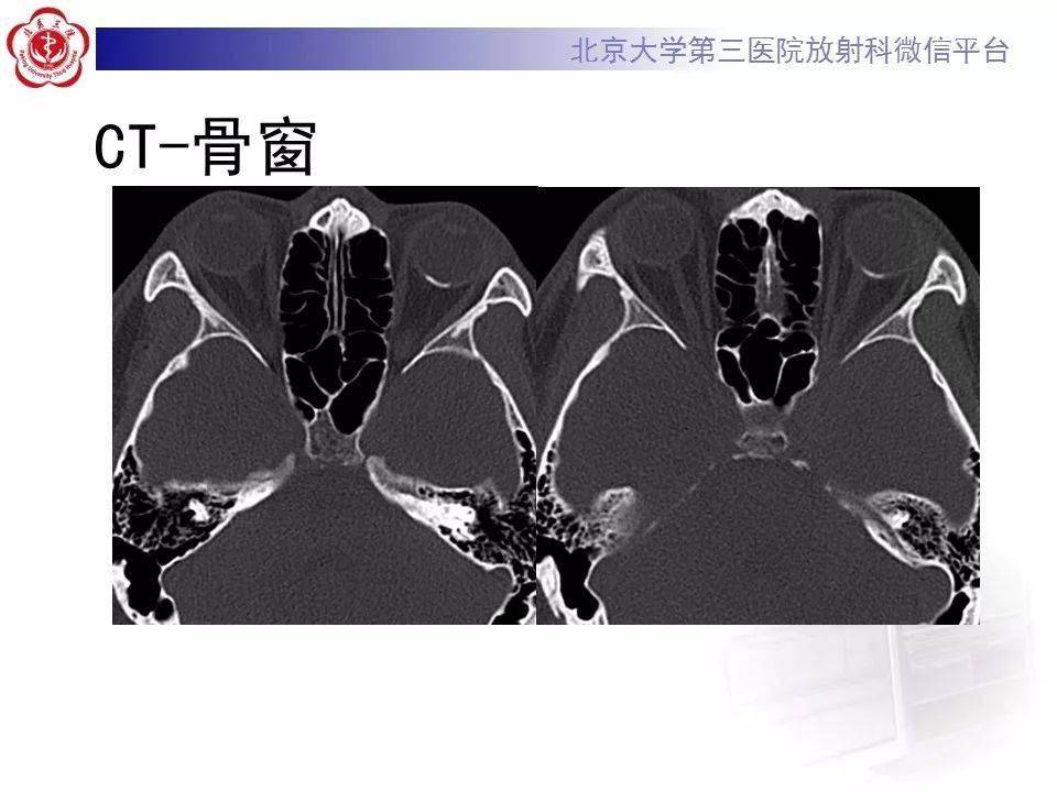 一看就会!脉络膜骨瘤影像表现