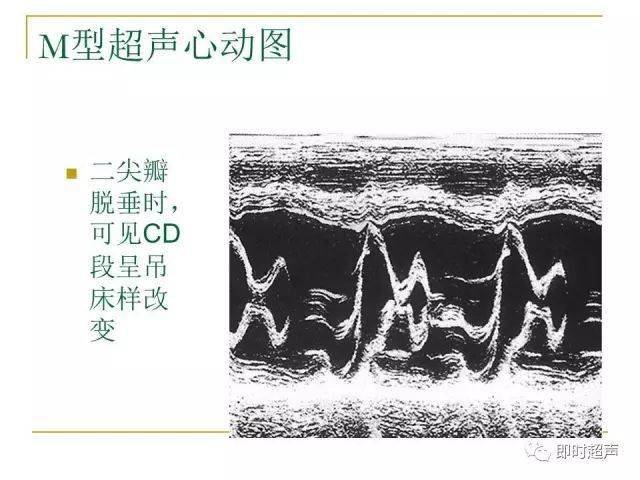 心脏瓣膜病超声诊断