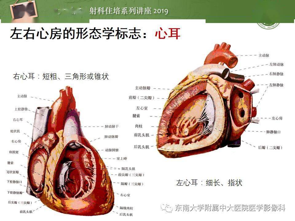 复杂先心病分段分析法简介_解剖图