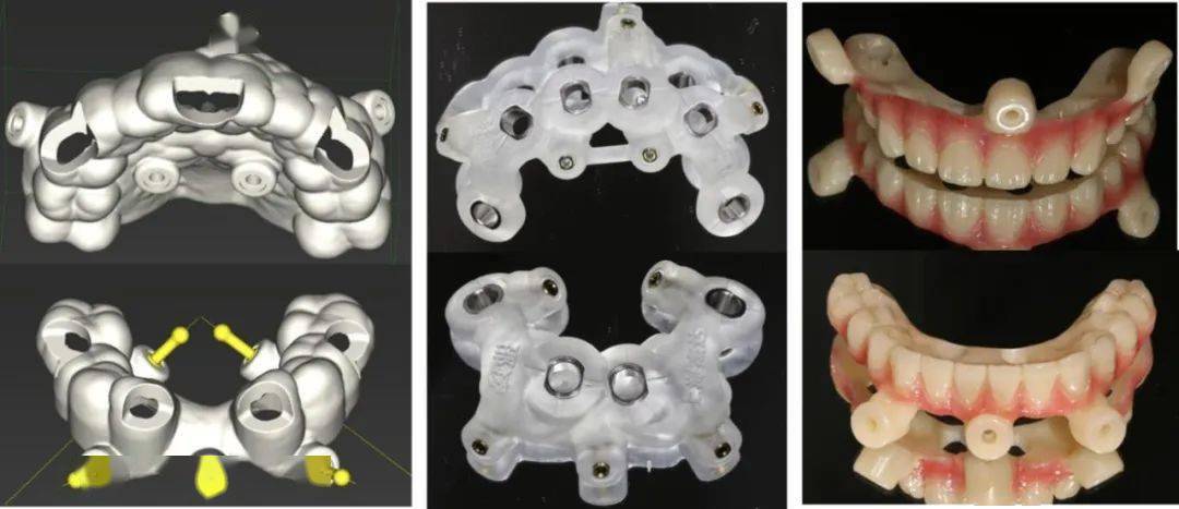 由左至右分别为牙支持固位钉导板,固位钉支持种植导板,固位钉辅助