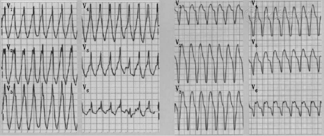 【基层常见疾病诊疗指南】室性心动过速基层诊疗指南
