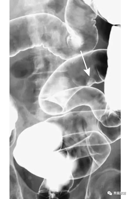 升结肠癌(箭)和横结肠浸润性腺癌(箭头).