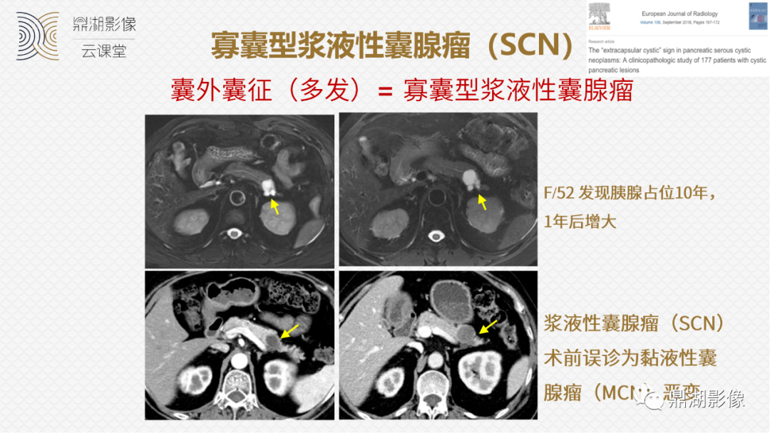 速记!十五大影像特征与胰腺病变