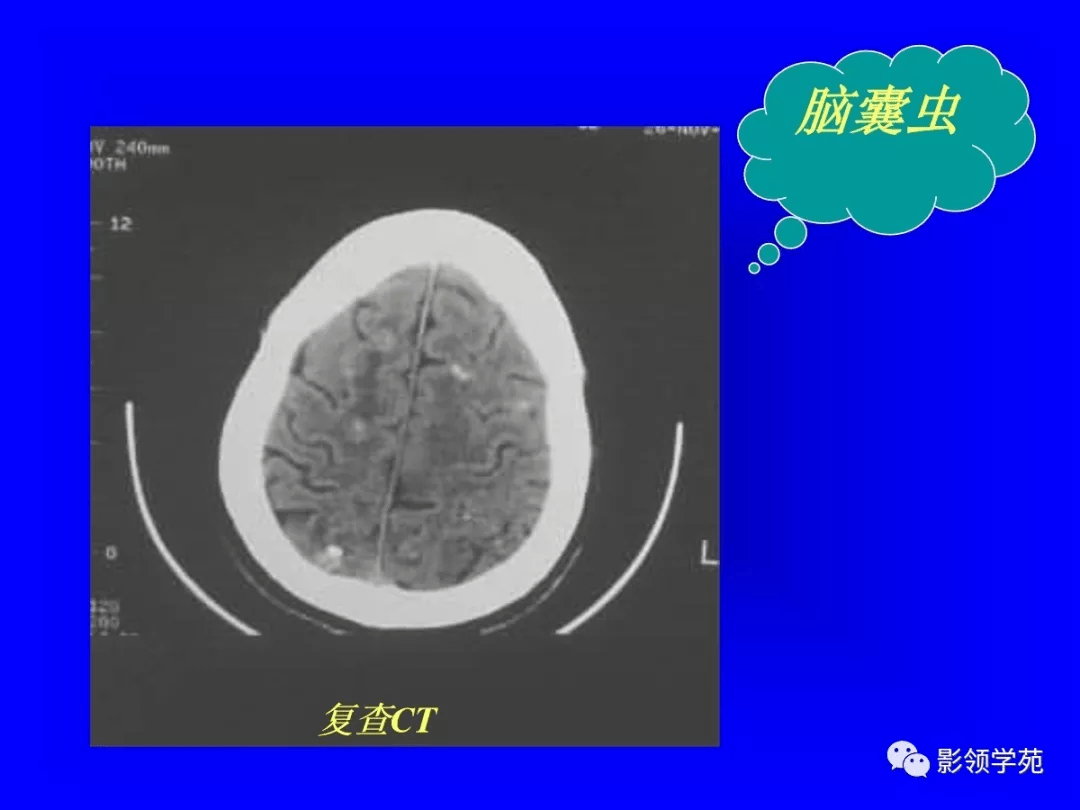 结核瘤 脑膜刺激征,发热,颅压高,结核病史 转移瘤 ns局灶体征,颅压高