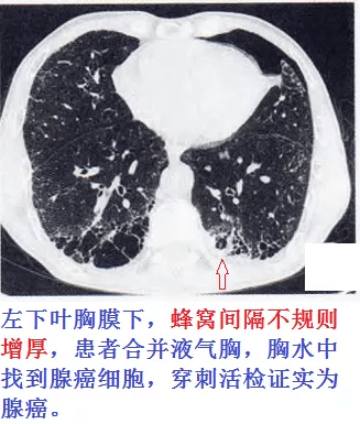 这份「肺纤维化 肺癌」读片秘籍,请收好