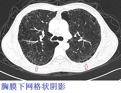 这份「肺纤维化 肺癌」读片秘籍,请收好