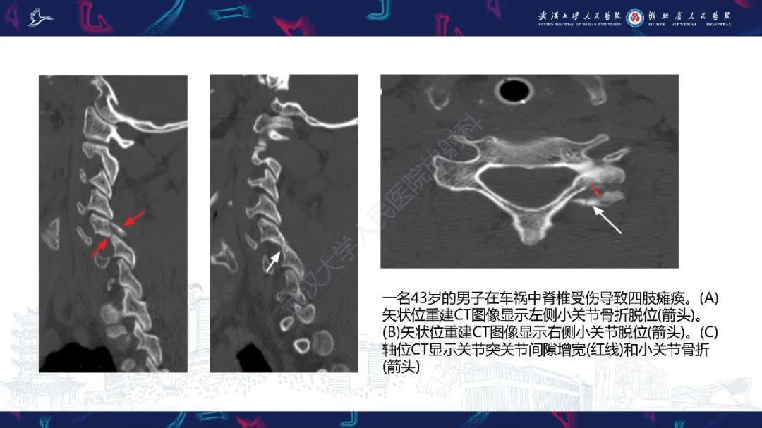 椎旁小关节病变影像诊断