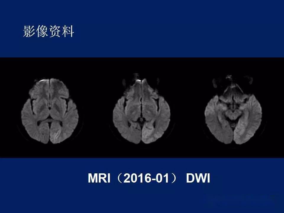 melas型线粒体脑病