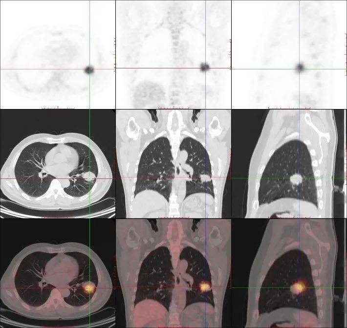 上排:pet图像;中排:ct图像;下排:pet/ct融合图像