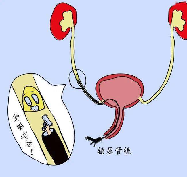 发现输尿管结石你可能还不会这么处理