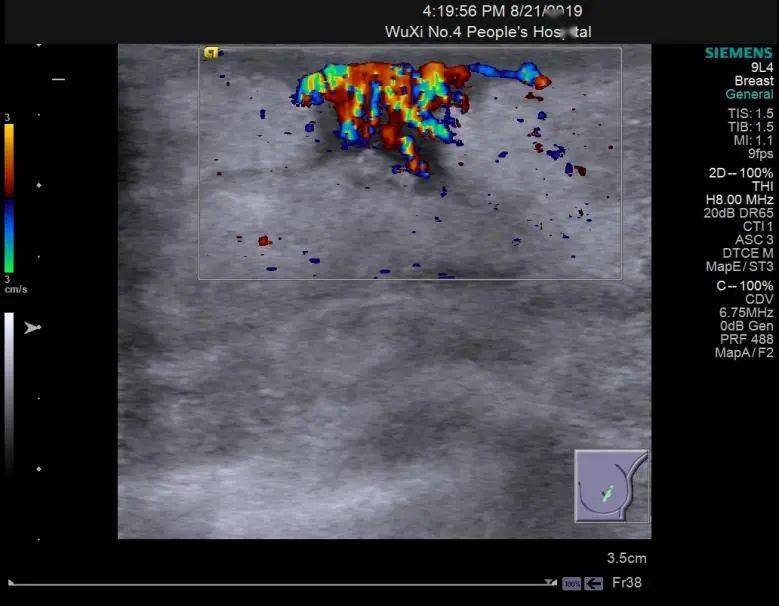 肿胀三天」入院超声提示左侧乳头体积增大,回声尚均匀(图 10 cdfi