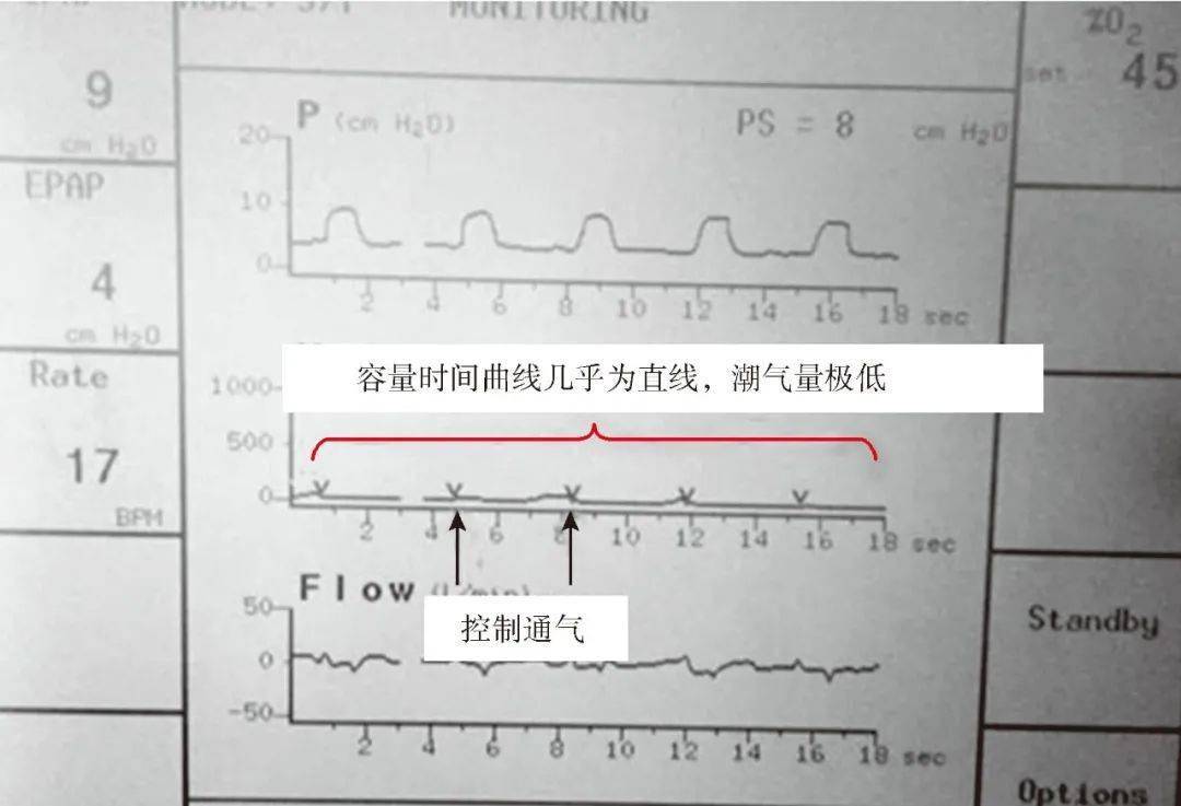 常见异常呼吸波形解读