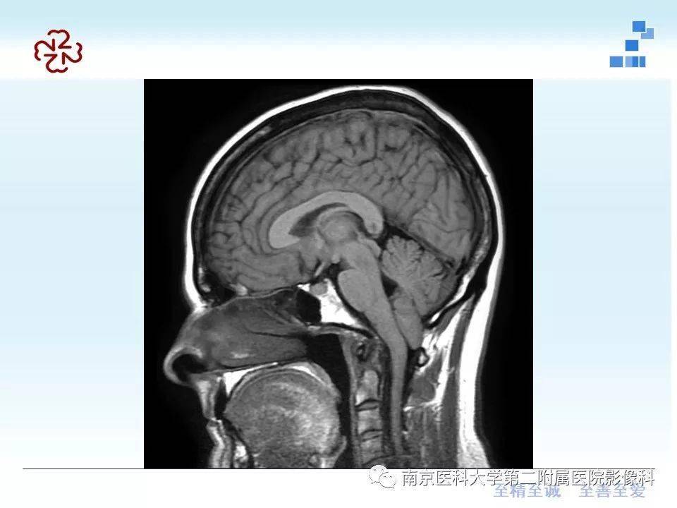 小脑扁桃体下疝畸形
