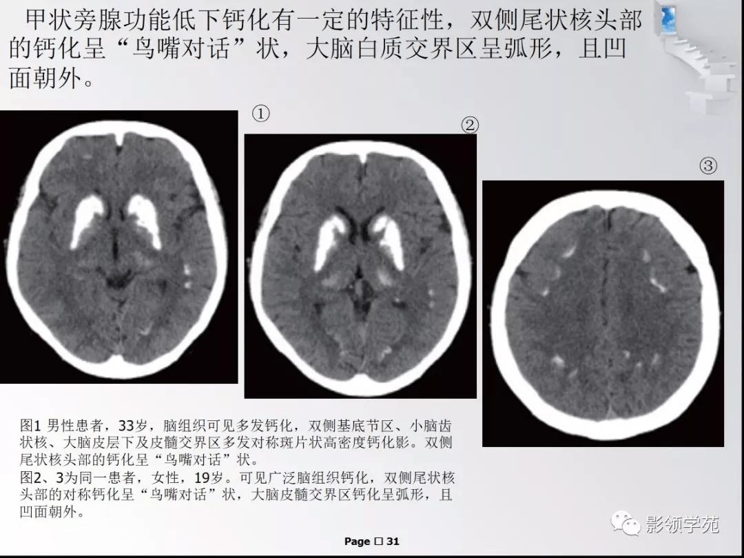 颅内钙化性病变