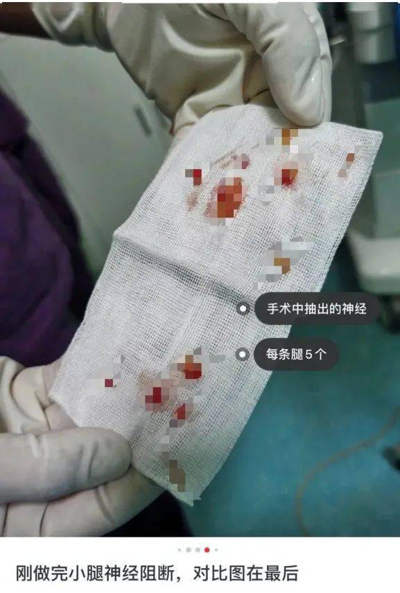 医生从她一双腿里抽出了十根神经,还把死去的神经拿给她拍照, 血腥到