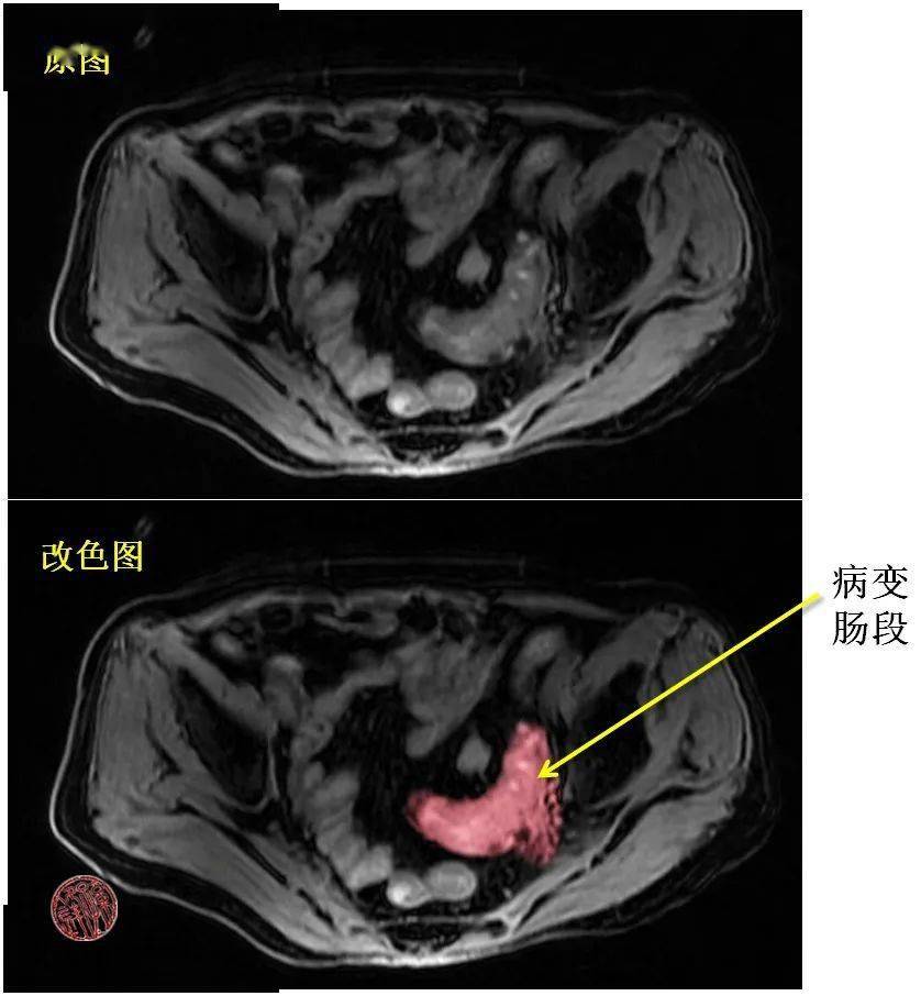 医学课堂|一例乙状结肠憩室炎患者的诊疗分析