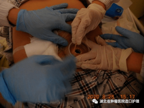 ②造口脱垂:选择一件式底盘或柔软两件式  ③造口皮肤粘膜分离:选择