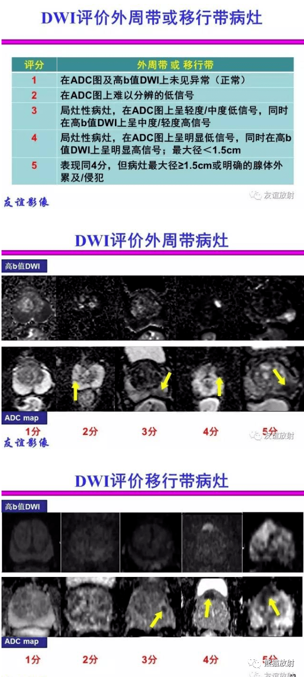 前列腺丨mri解剖分区  解读丨前列腺影像报告和数据系统(pi-rads 2..