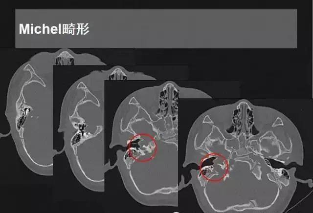 先天性内耳畸形影像学诊断