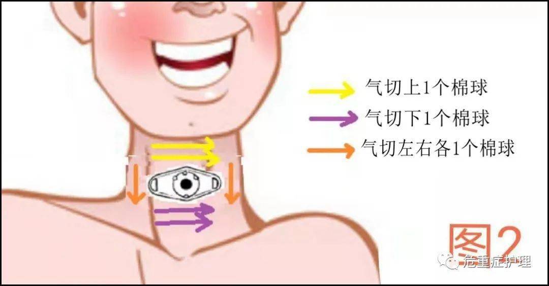 图文并茂:气管切开患者这样换药!