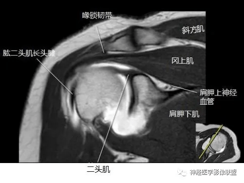 肩关节磁共振断层解剖