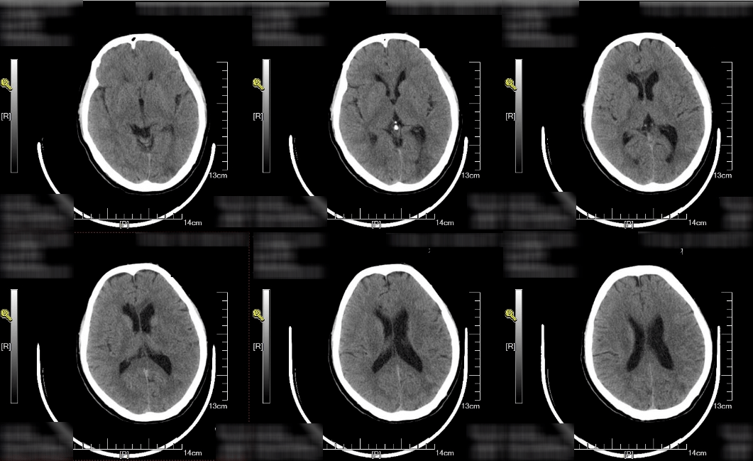 头颅ct提示多发腔隙性脑梗死.