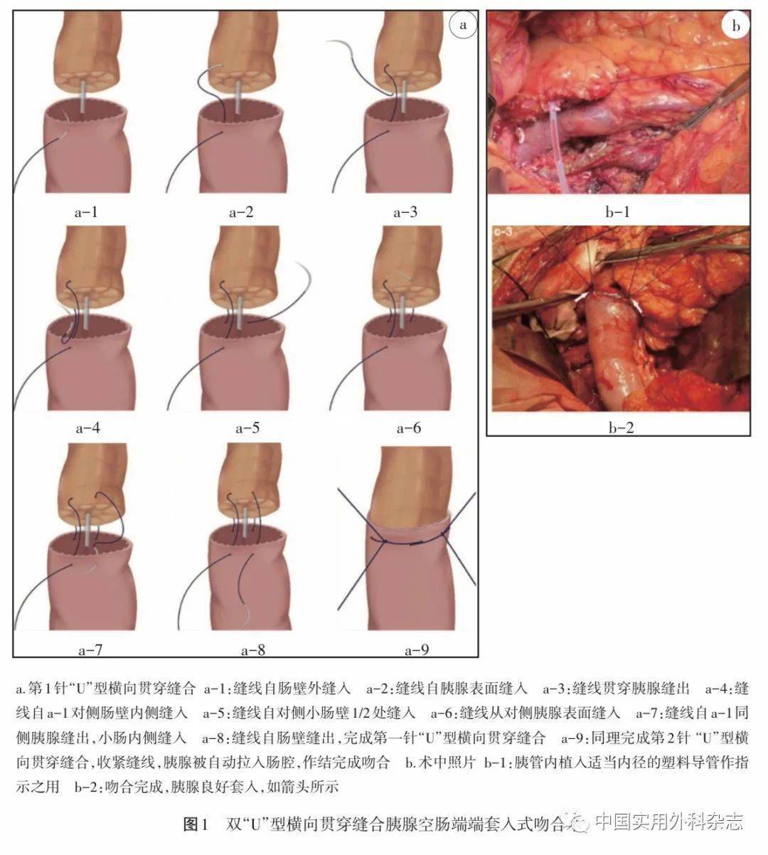 专家论坛 | 陈氏贯穿纵向"u"型胰肠吻合术的理论与实践(本文配发视频)