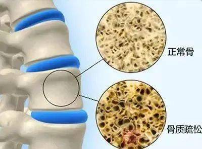 骨质疏松性胸腰椎压缩性骨折