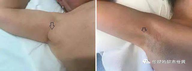 超声解剖61腋窝包块之朗格腋弓