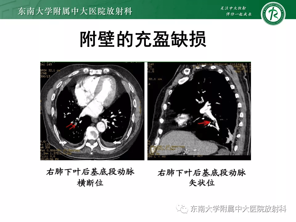 肺动脉栓塞的影像诊断