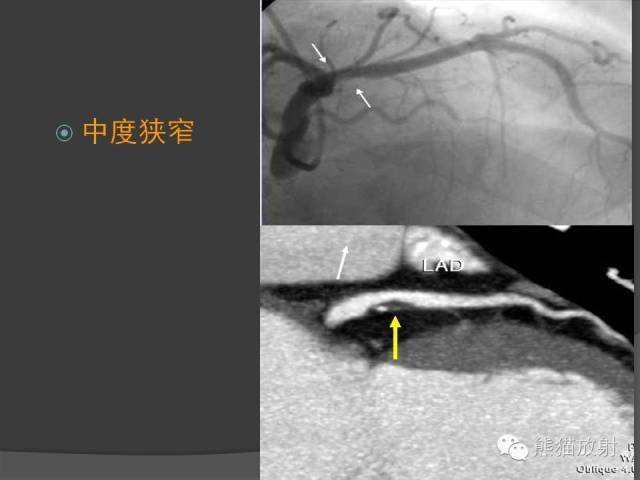 冠状动脉斑块评估管腔狭窄程度分级