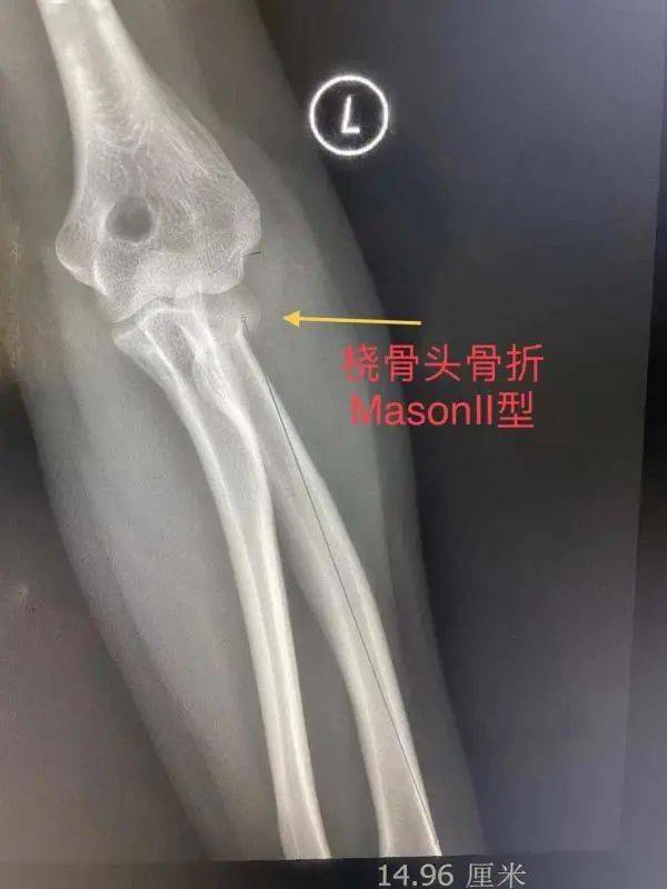 鲁某左侧桡骨小头骨折后,他们为其实施了克氏针内固定术,即通过c 型臂