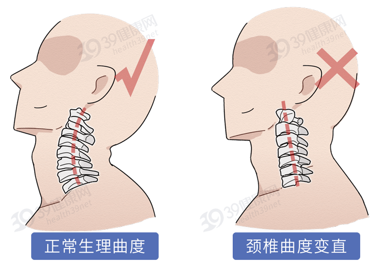 变形的颈椎会压迫颈动脉 导致颈性高血压 引起上肢麻木,颈部疼痛等