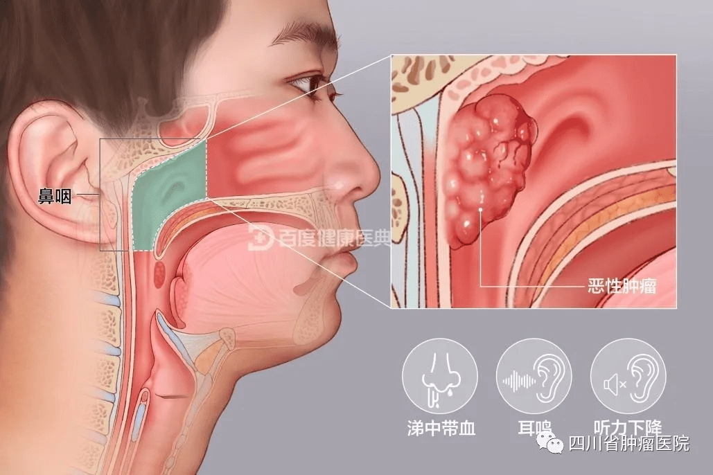 头痛 张口困难 面部麻木,复视,视力下降,伸舌受限,声嘶或说话不