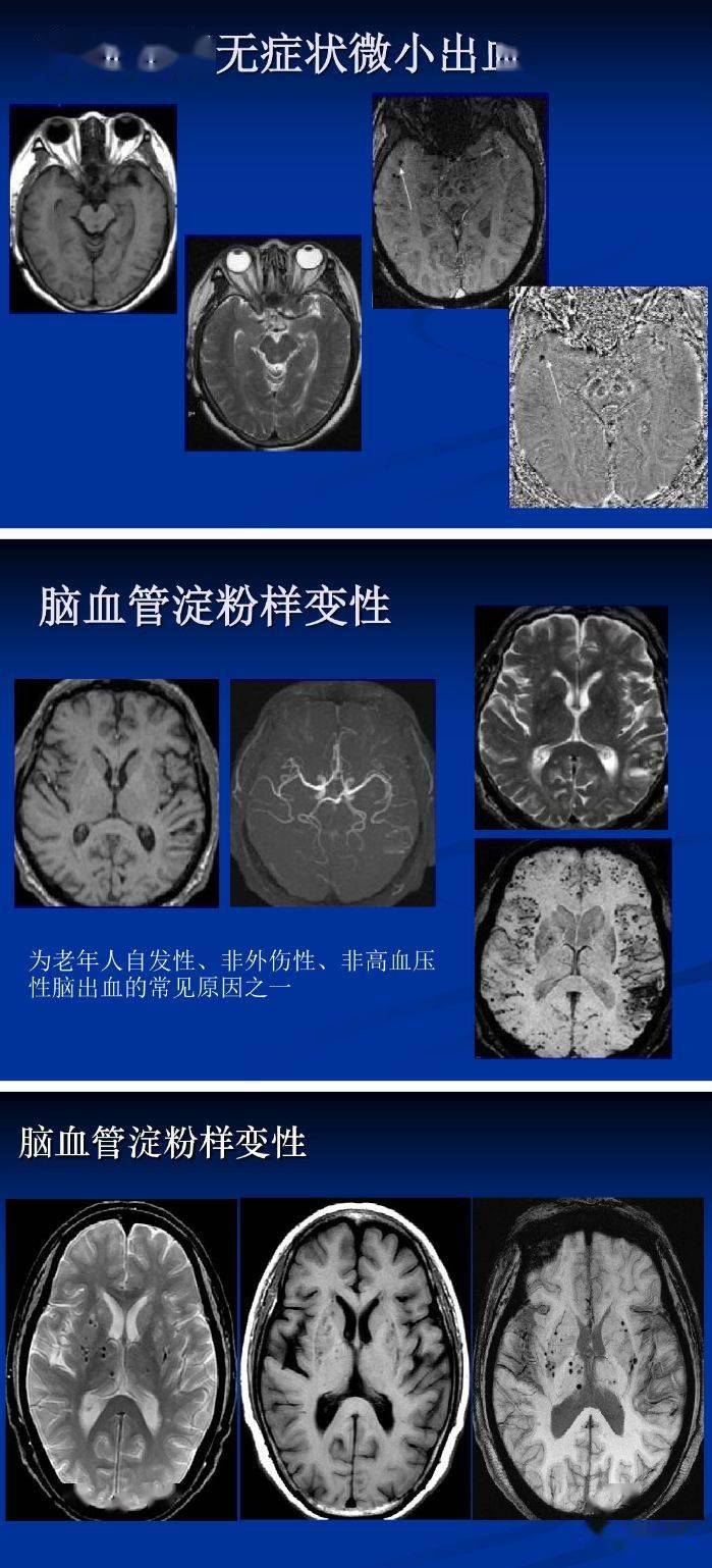 磁敏感加权成像(swi)详细临床应用_解剖图