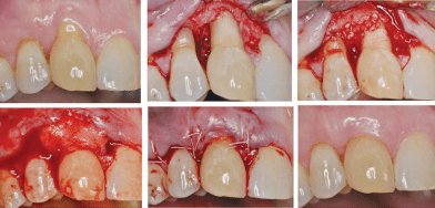 经积极治疗,重度牙周炎部分患牙牙周袋消除后,如果根方角化龈组织宽度