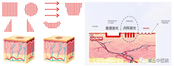 点阵激光(fractionallaser)并非是激光器,而是指激光器的一种工作模式