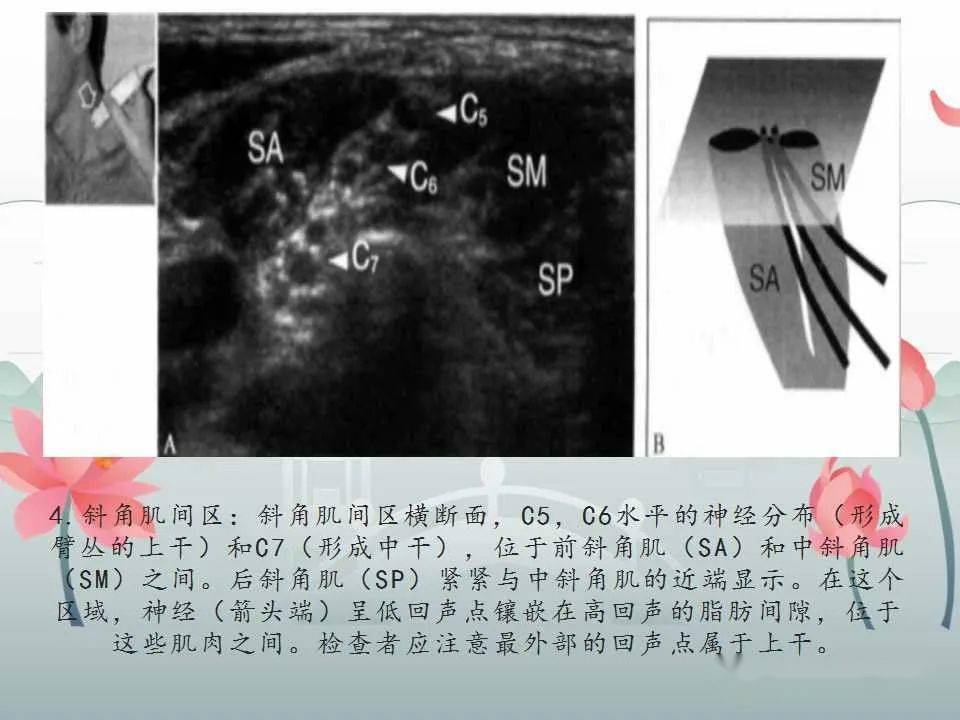 文献阅读与病例讨论臂丛神经的解剖与超声扫查