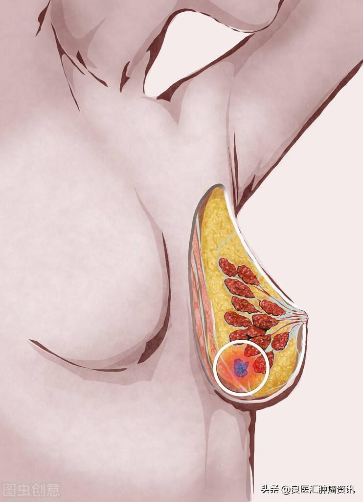 乳腺癌的乳房和健康的乳房"看起来"有什么不同?主要在