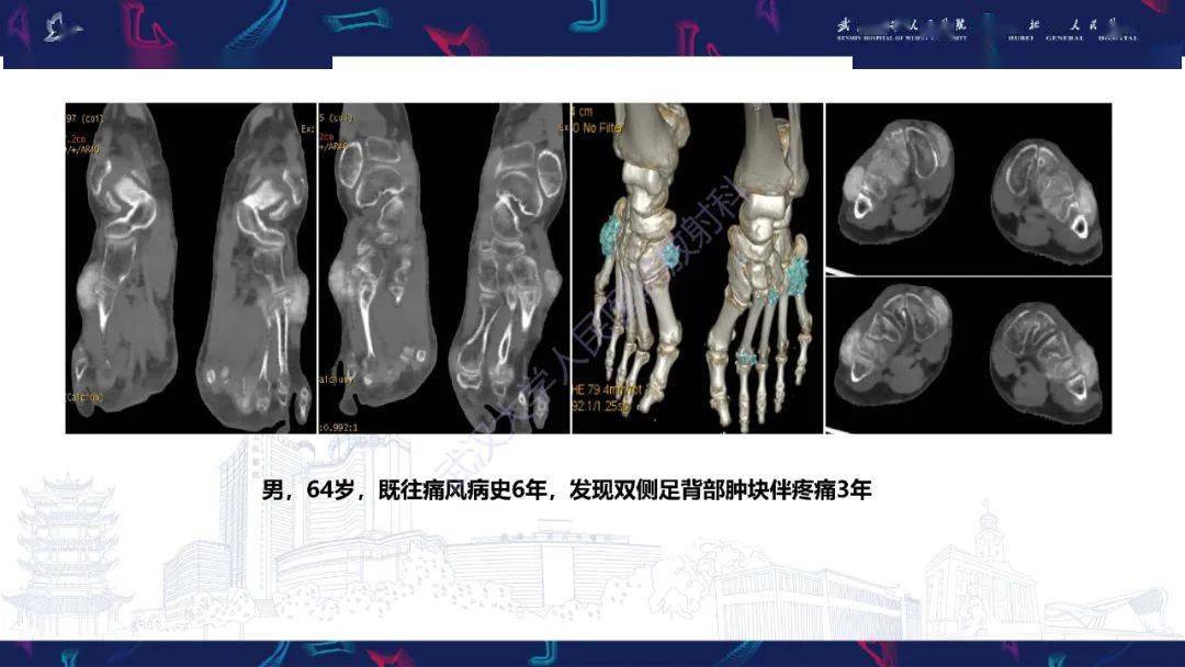 关节痛风影像诊断