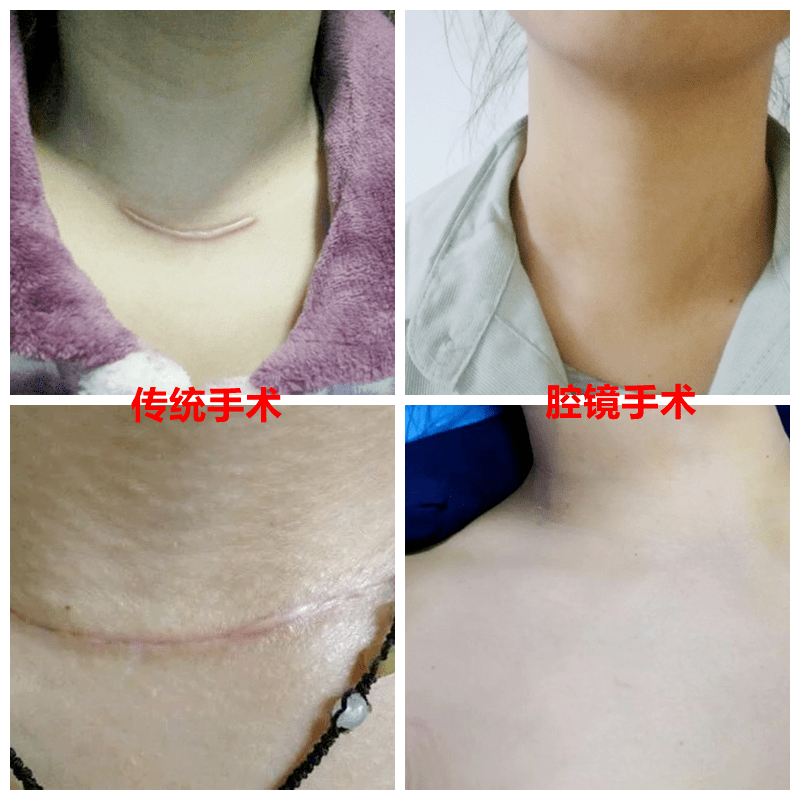 与传统开放手术相比,经腋窝腔镜甲状腺手术具有明显的优势.